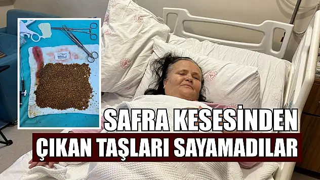 Safra kesesinden çıkan taşları sayamadılar