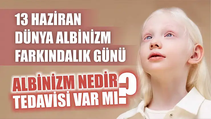 13 Haziran Dünya Albinizm Farkındalık Günü: Albinizm nedir? Albinizmin tedavisi var mı?