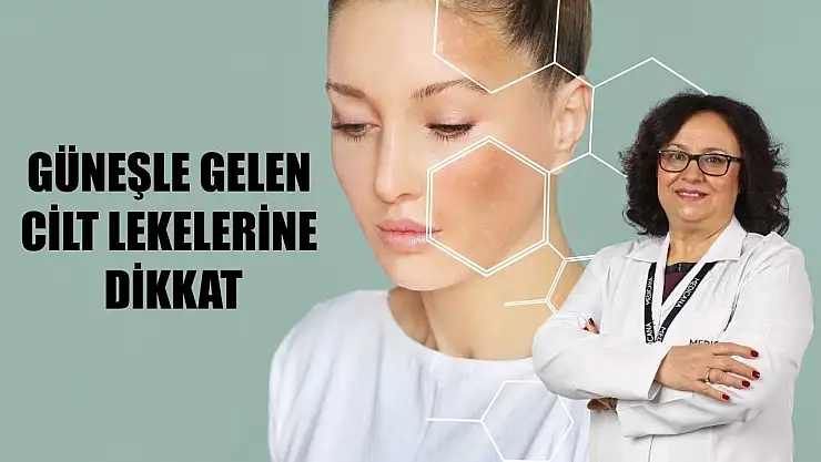 Güneşle gelen cilt lekelerine dikkat