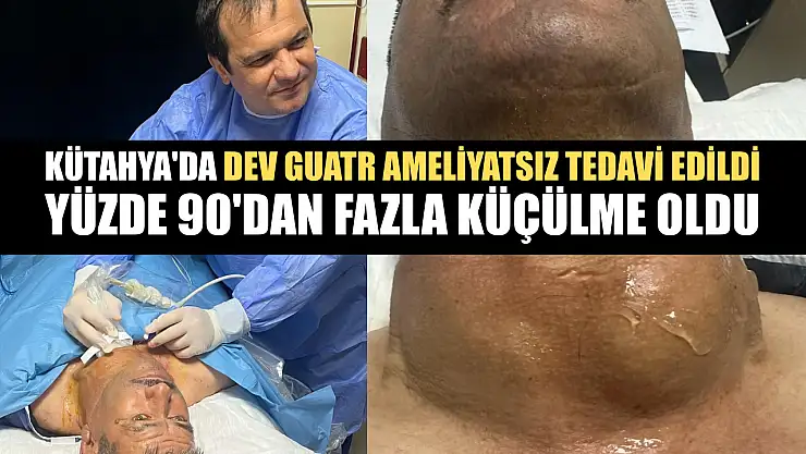Kütahya'da dev guatr ameliyatsız tedavi edildi: Yüzde 90'dan fazla küçülme oldu