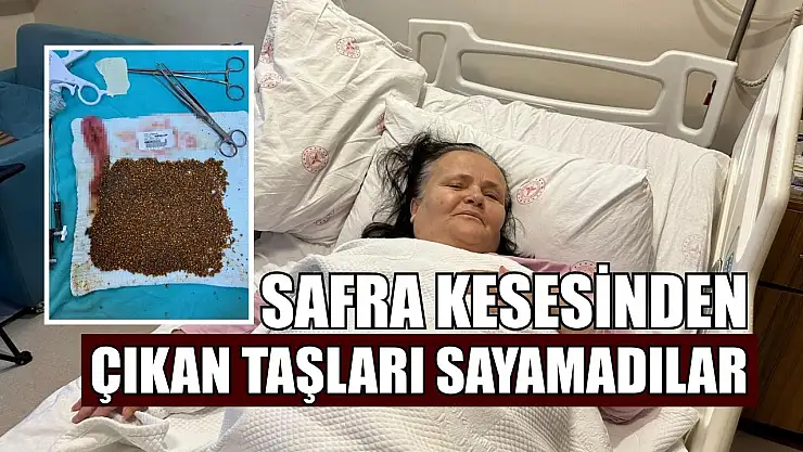 Safra kesesinden çıkan taşları sayamadılar