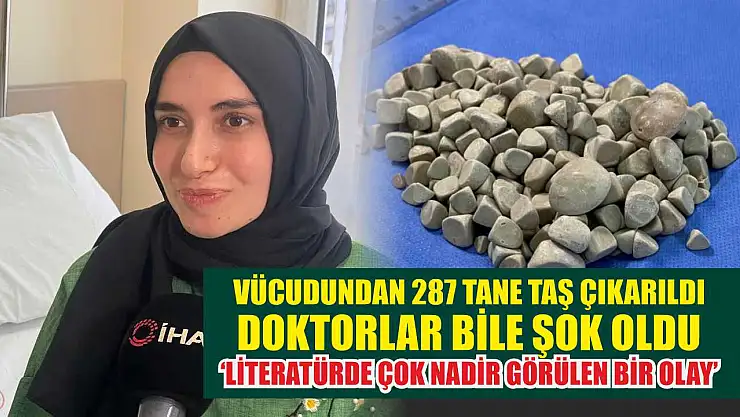 Vücudundan 287 tane taş çıkarıldı, doktorlar bile şok oldu: 'Literatürde çok nadir görülen bir olay'