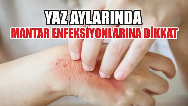 Yaz aylarında mantar enfeksiyonlarına dikkat