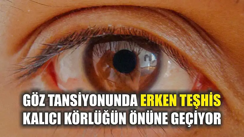 Göz tansiyonunda erken teşhis kalıcı körlüğün önüne geçiyor