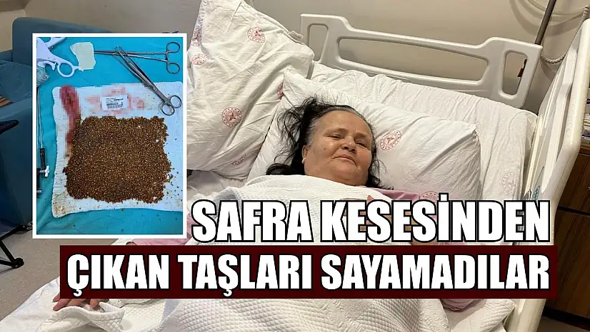 Safra kesesinden çıkan taşları sayamadılar