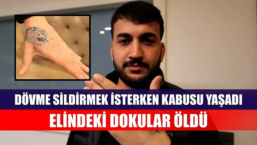 Dövme sildirmek isterken kabusu yaşadı, elindeki dokular öldü