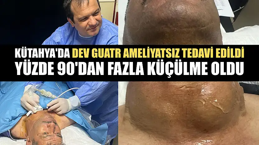 Kütahya'da dev guatr ameliyatsız tedavi edildi: Yüzde 90'dan fazla küçülme oldu