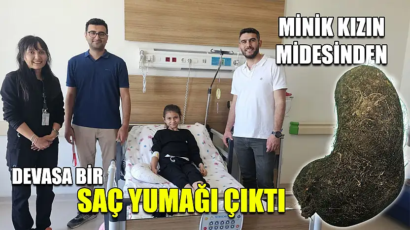 Minik kızın midesinden devasa bir saç yumağı çıktı