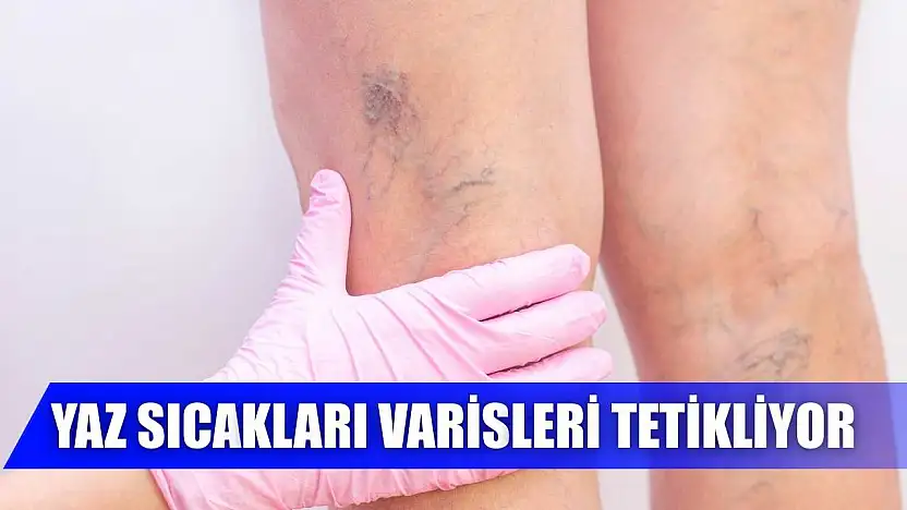 Yaz sıcakları varisleri tetikliyor
