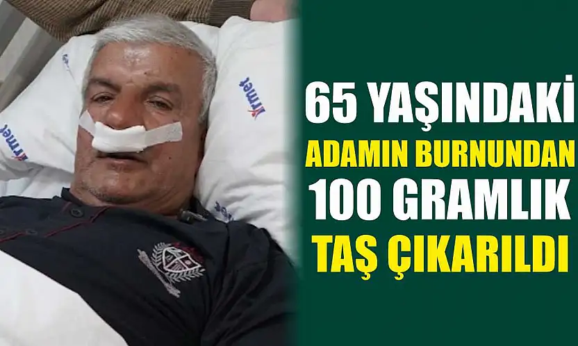65 yaşındaki adamın burnundan 100 gramlık taş çıkarıldı