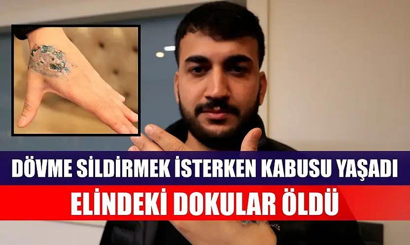 Dövme sildirmek isterken kabusu yaşadı, elindeki dokular öldü