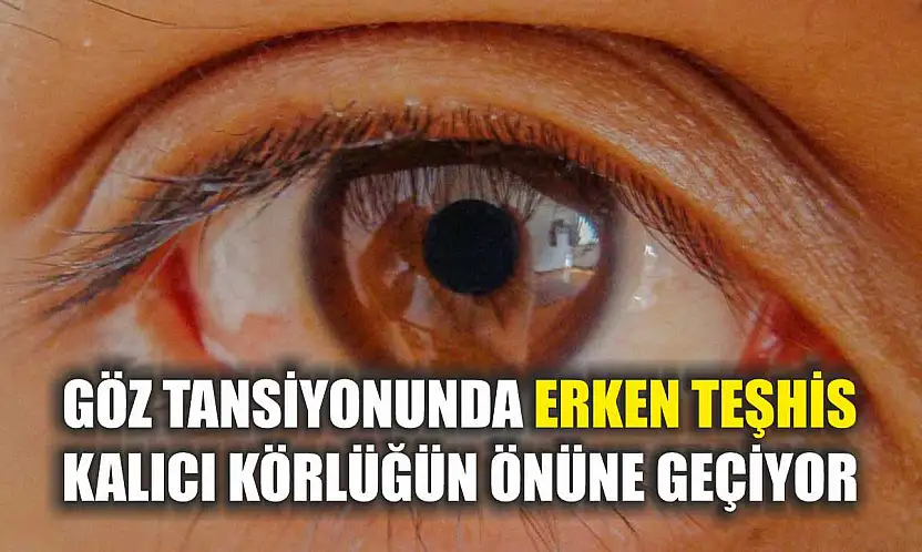 Göz tansiyonunda erken teşhis kalıcı körlüğün önüne geçiyor