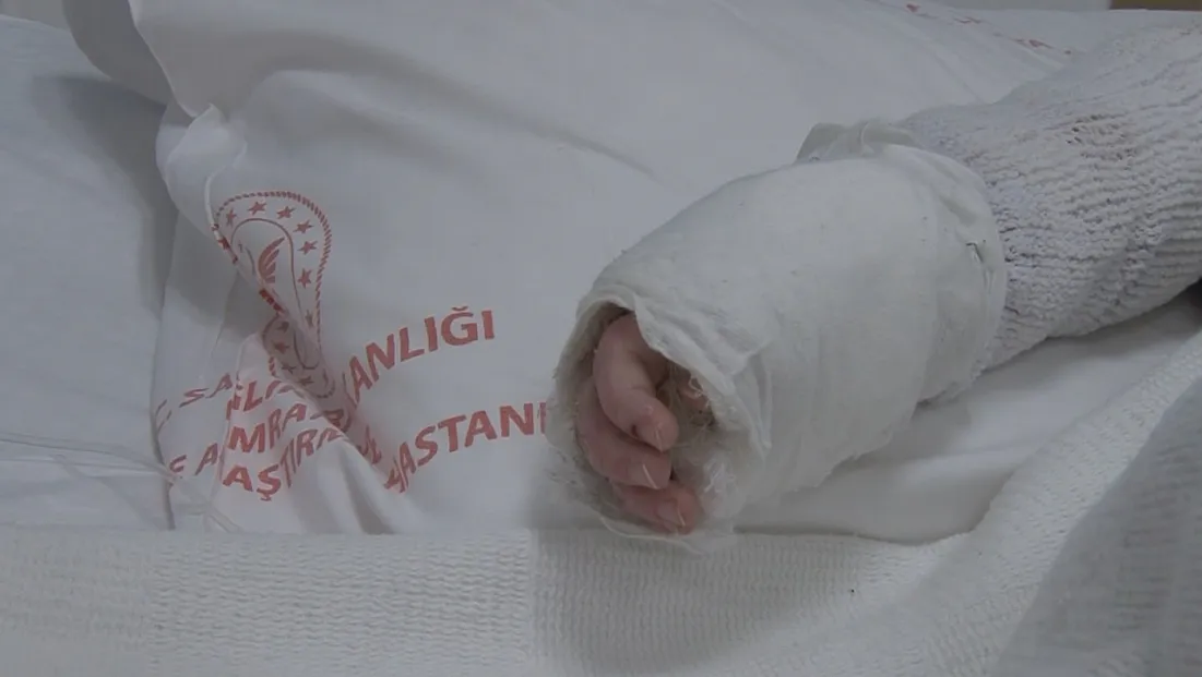 Üzerine kaynar su dökülen bebeğin vücudunun yüzde 27'si yandı