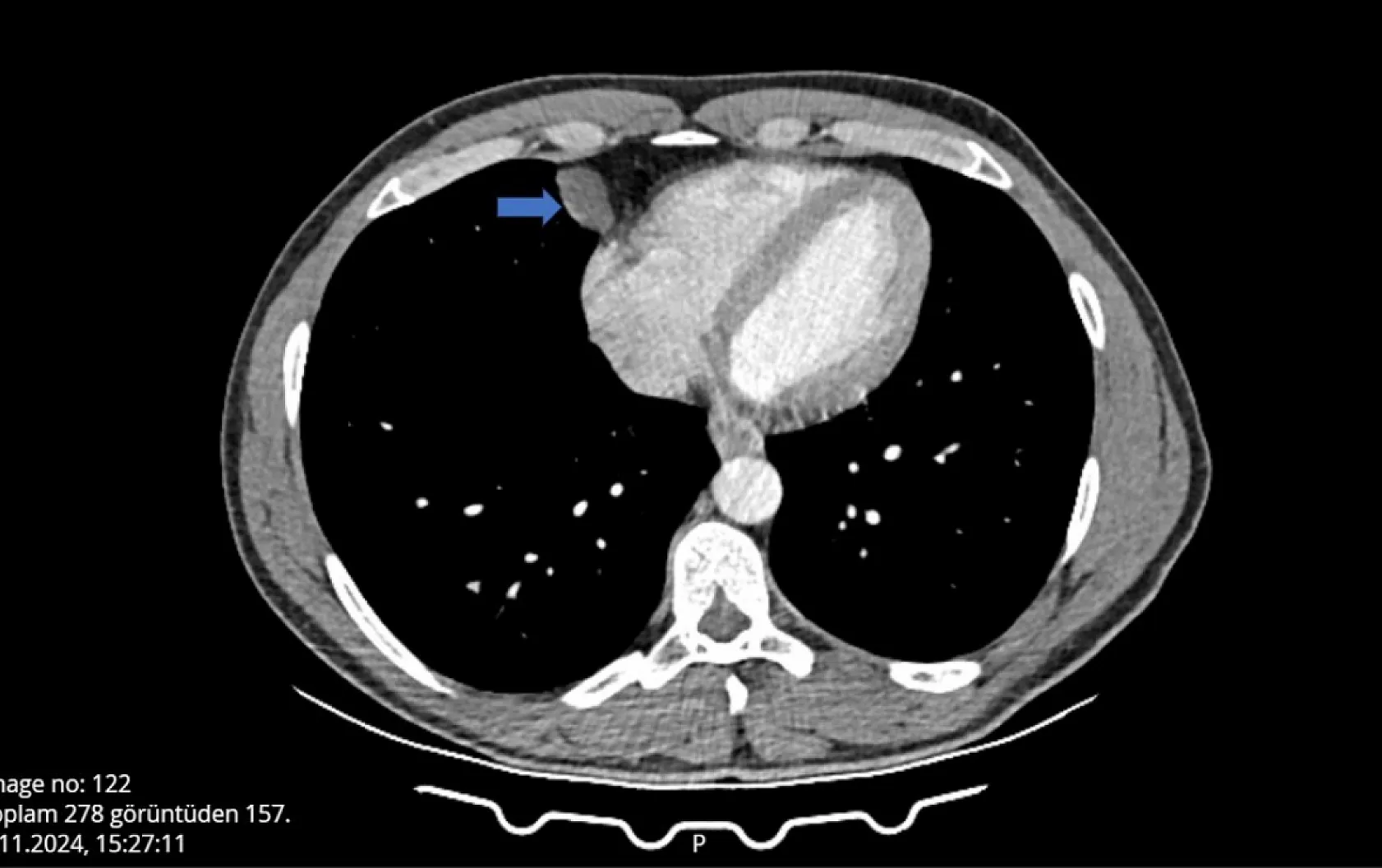 Öksürük ve hapşırık krizine girdi, hayatının şokunu yaşadı