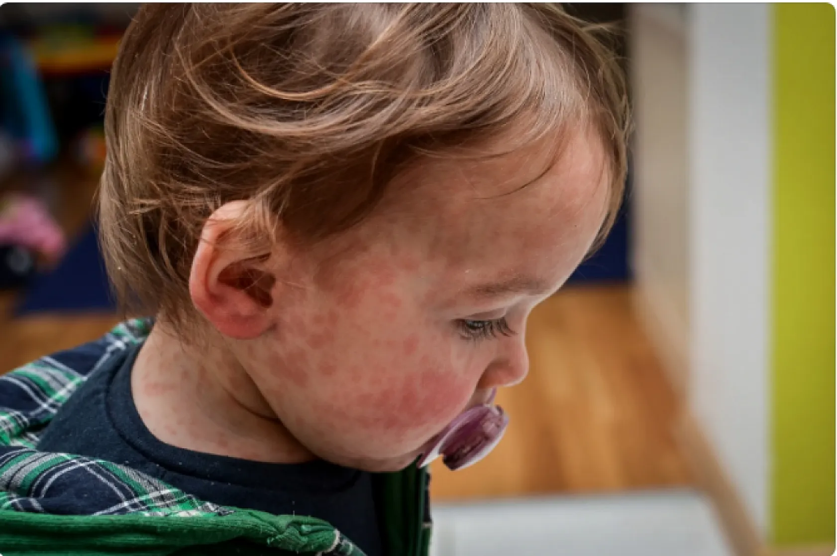 Kızamık vakaları yükseliyor! Aşısız çocuklar hastaneye yatırıldı