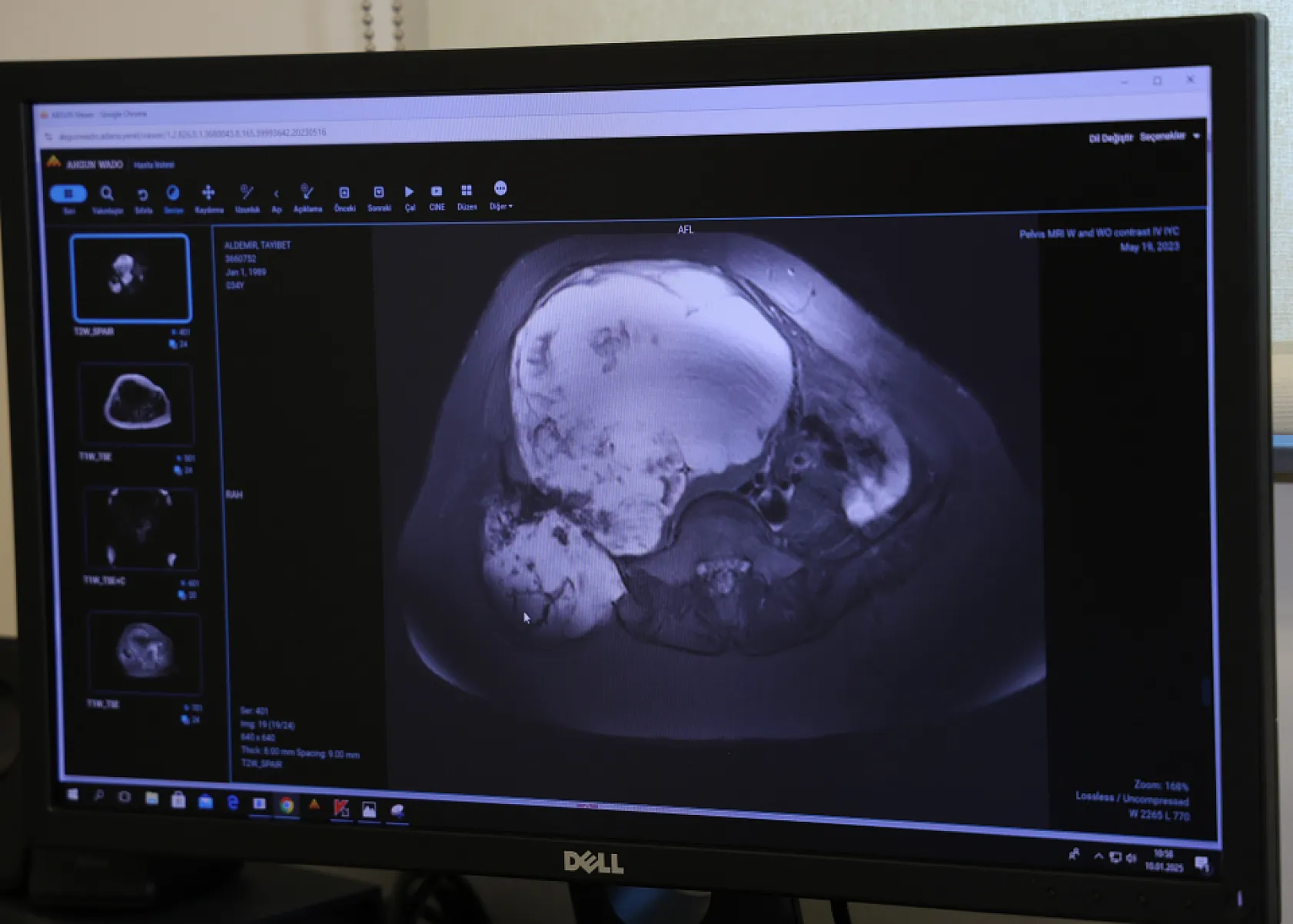 Hayat Kurtaran Nadir Ameliyat 'Ya ölürsün ya da bacağın kesilir'