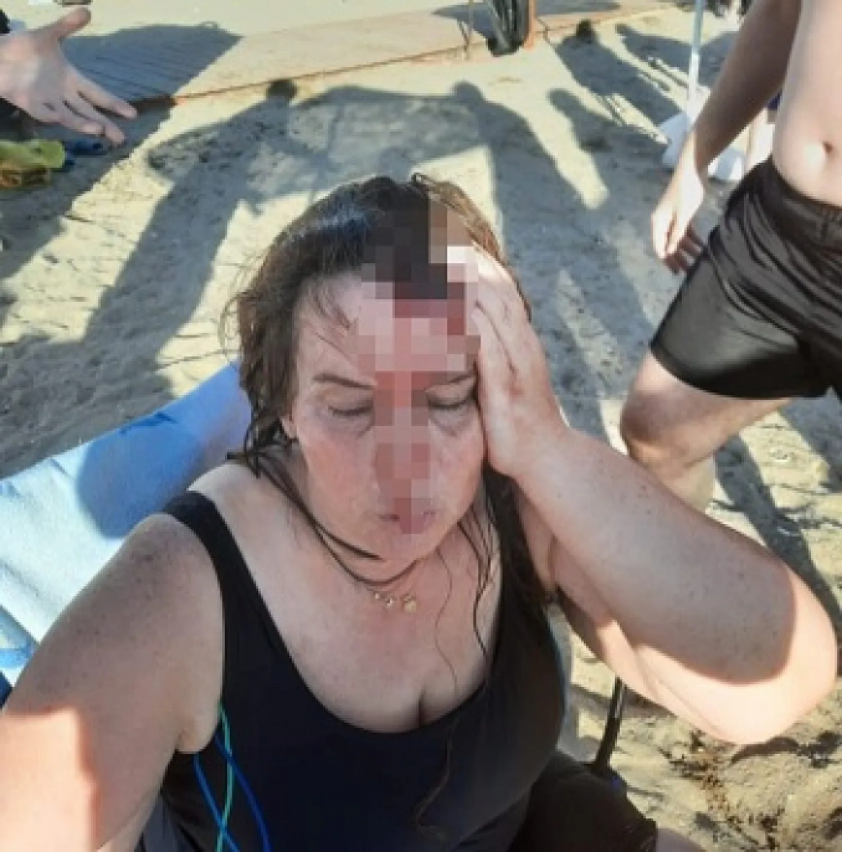 Denizde yüzerken jet ski çarptı, ölümden döndü