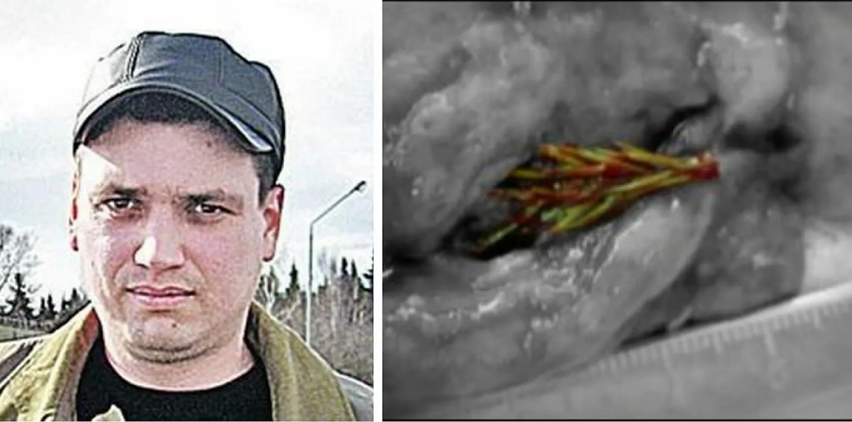 Akciğerinde Köknar Ağacı Büyüyen Adam Tıp Dünyasını Şaşkına Çevirdi