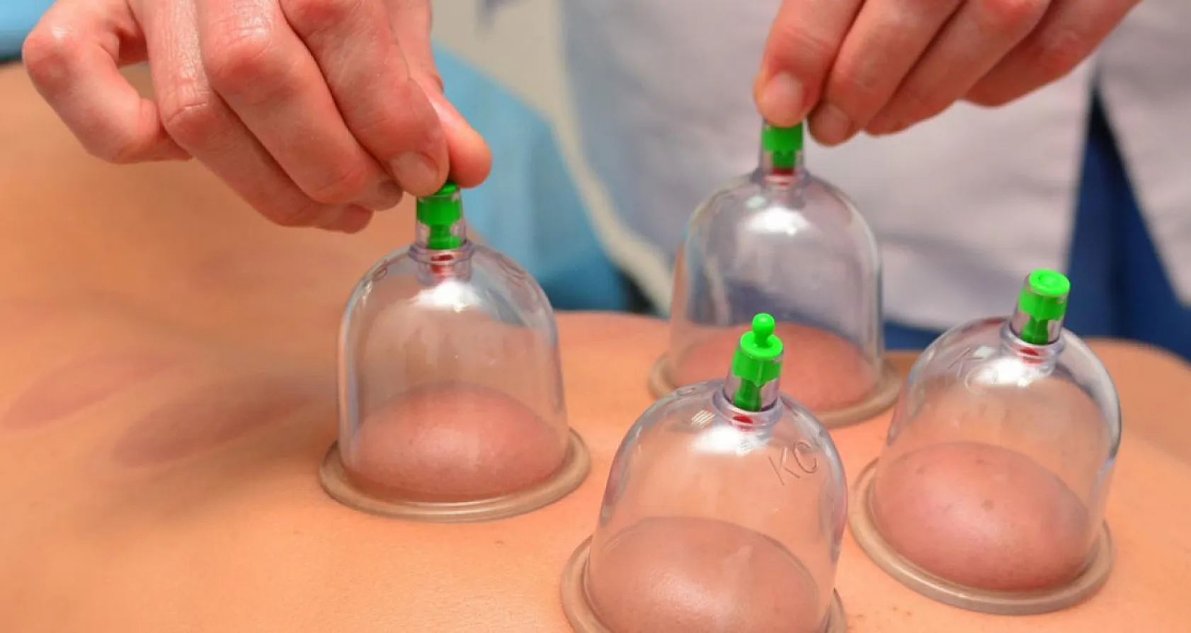 Kaliteli yaşam için 'Hacamat'