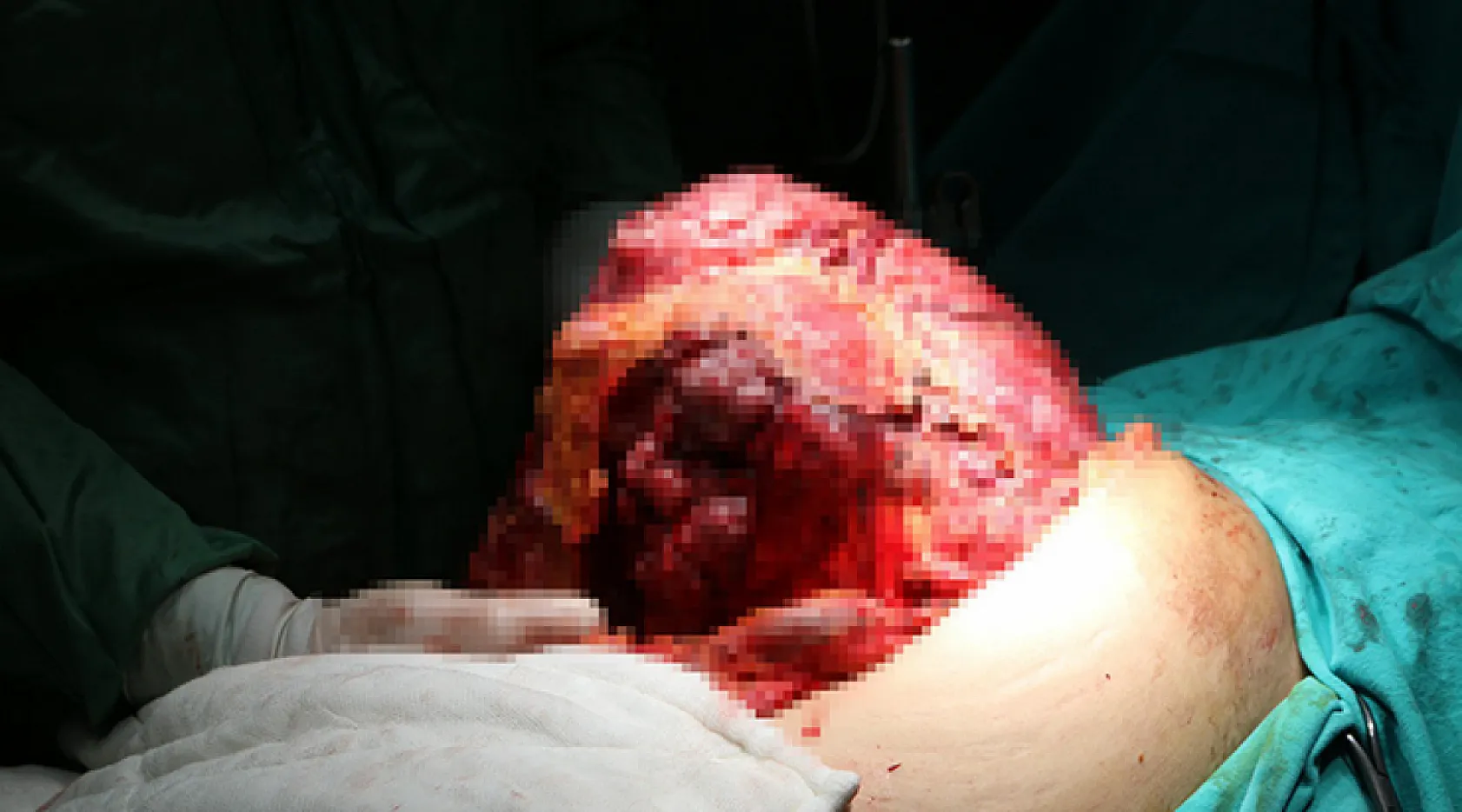 Karın Ağrısı Şikayetiyle Gitti, 10 Kiloluk Dev Tümör Çıkartıldı