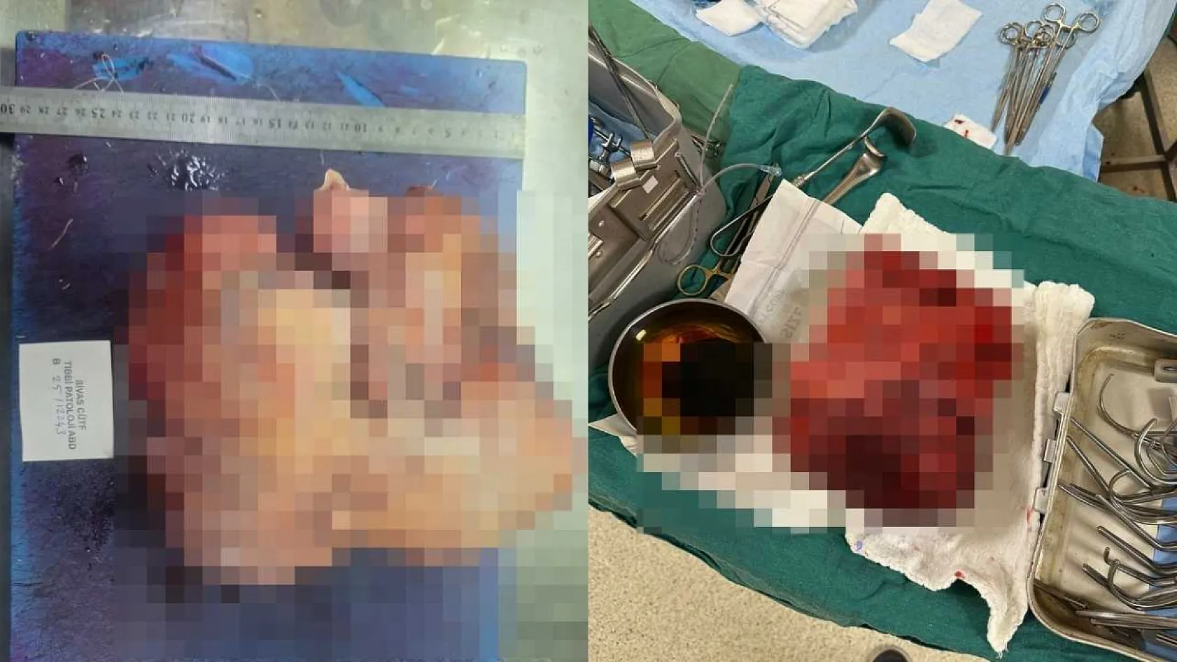 Nefes darlığı şikayeti ile hastaneye gitti, göğsünden 3 kilogramlık tümör çıktı