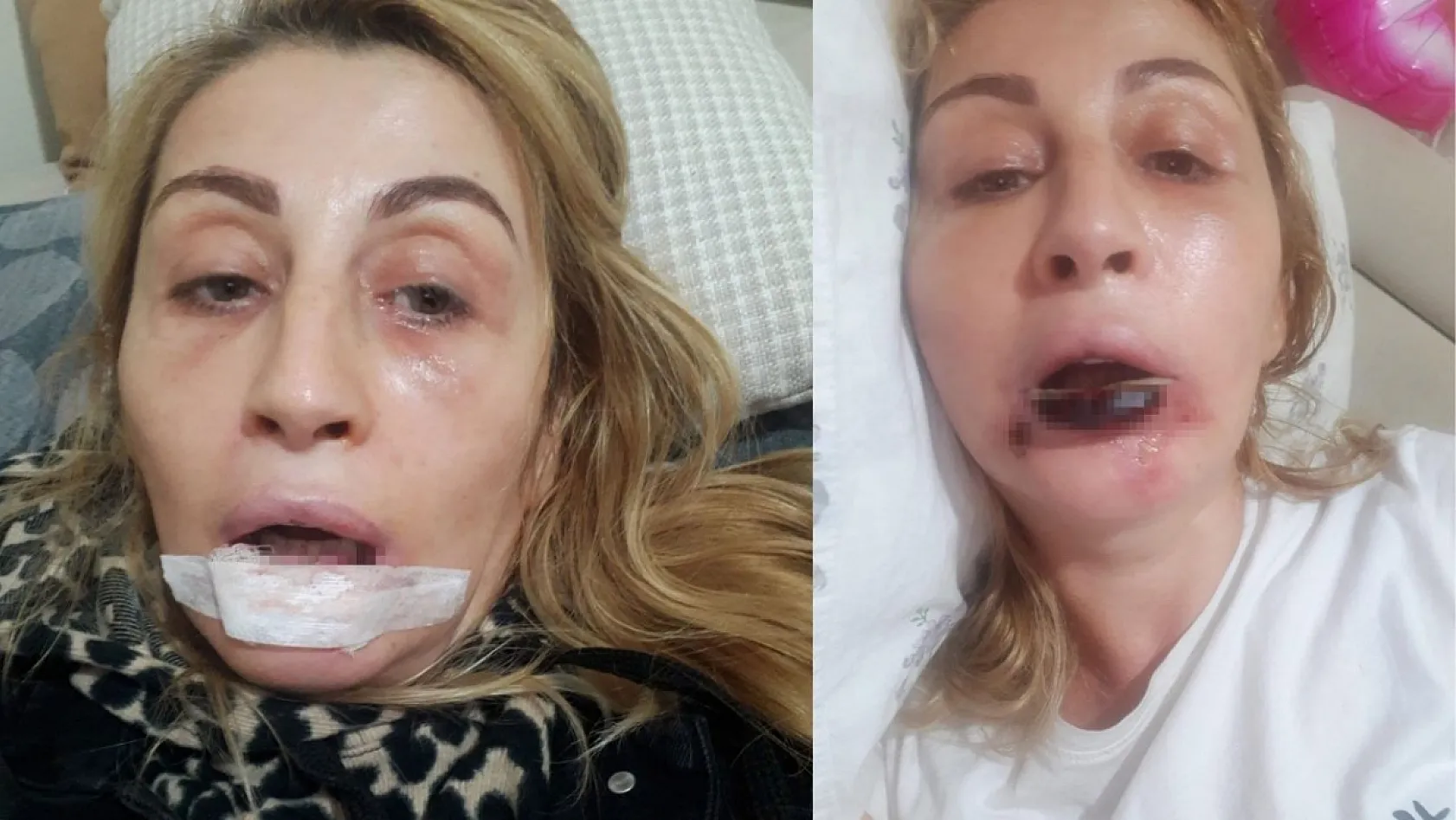 Estetik işlem sonrası dudağı çürüdü, 7 yıldır hukuk mücadelesi veriyor