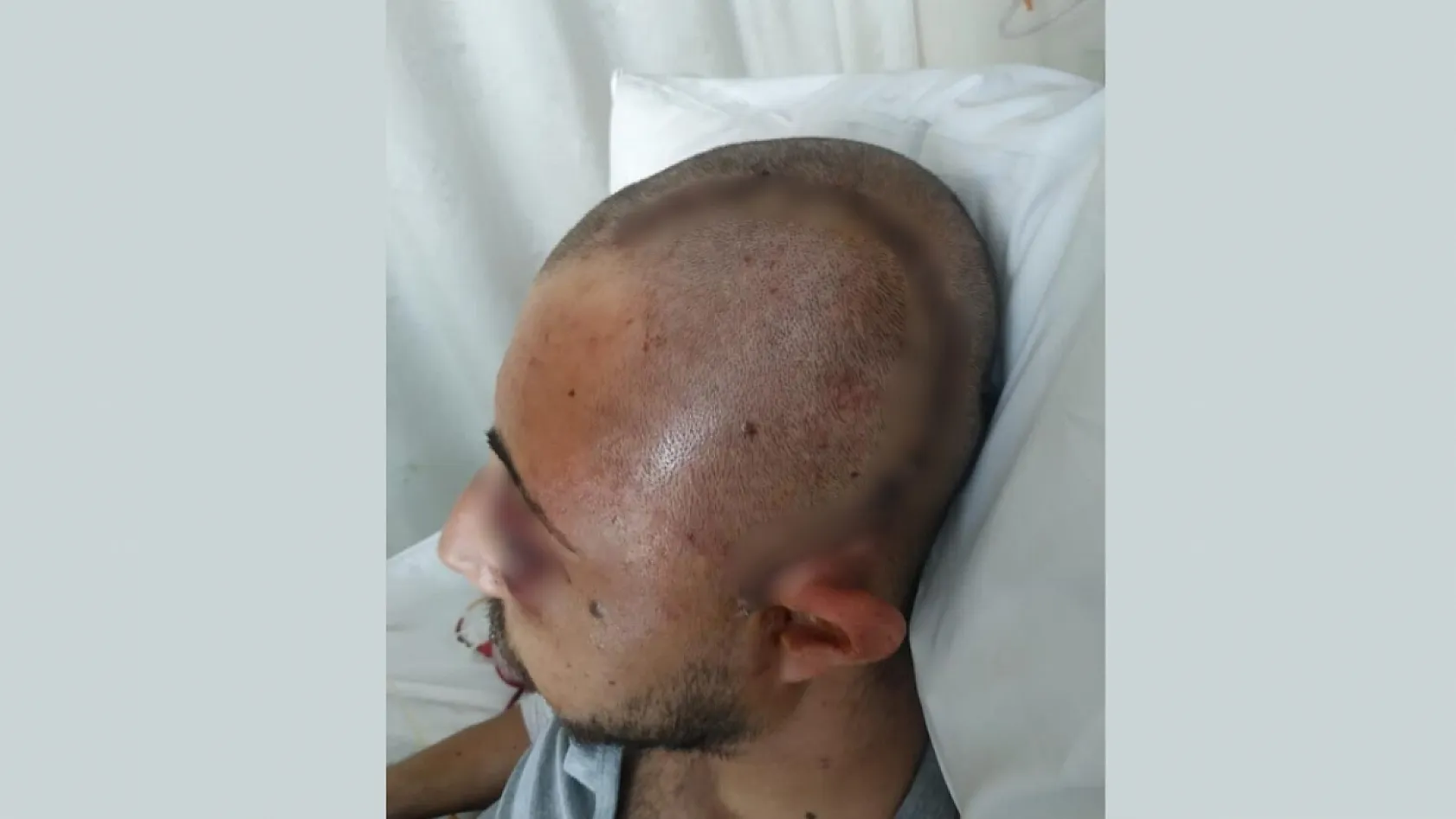 Patronunun öldüresiye darp ettiği çalışan yüzde 32 fiziksel engelli kaldı