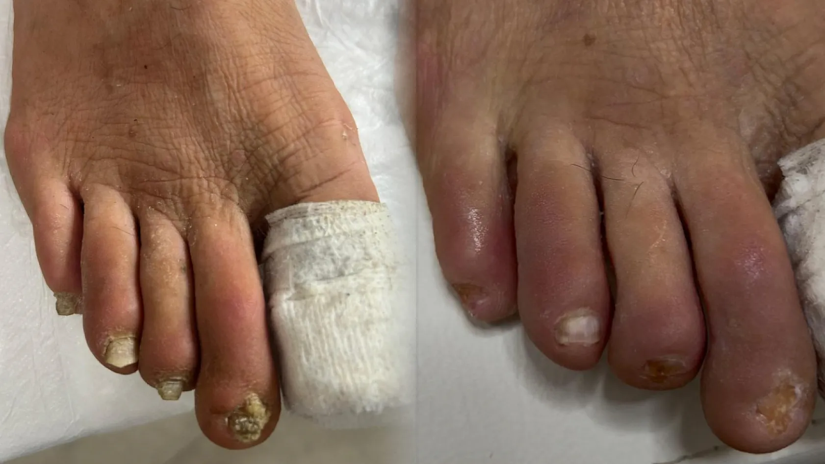 Fethiye Ayak Sağlığı Merkezi Kurucusu Serpil Özcan: 'Diyabetik Ayakta Erken Farkındalık Büyük Önem Taşıyor'