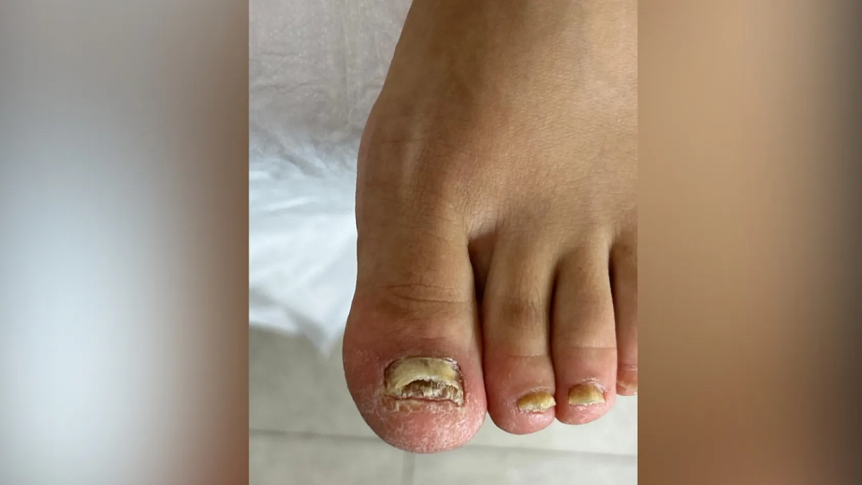 Fethiye'de Uzman Podolog Serpil Özcan'dan uyarı: 'Mantarlı tırnak kendiliğinden geçmez'