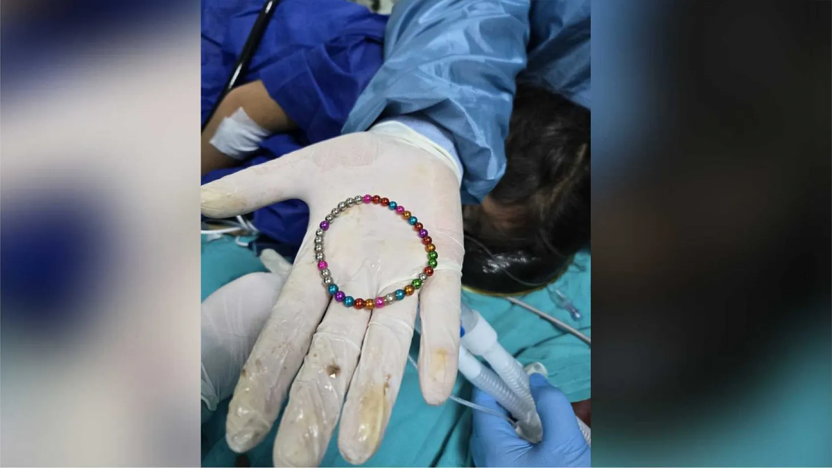 5 yaşındaki çocuğun bağırsağından 38 adet mıknatıs çıkarıldı