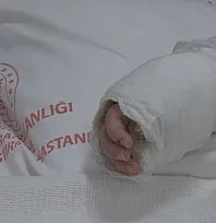 Üzerine kaynar su dökülen bebeğin vücudunun yüzde 27'si yandı