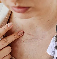 Uzmanlar uyardı: 'Basit leke zannettiğimiz bir lezyon cilt kanseri de olabilir'