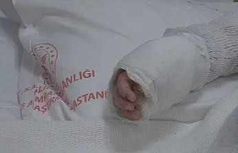 Üzerine kaynar su dökülen bebeğin vücudunun yüzde 27'si yandı