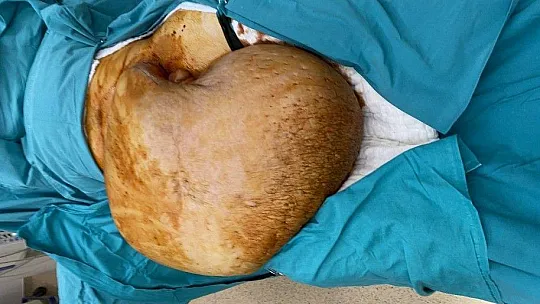 Bedeninden tam 35 kiloluk kitle çıktı