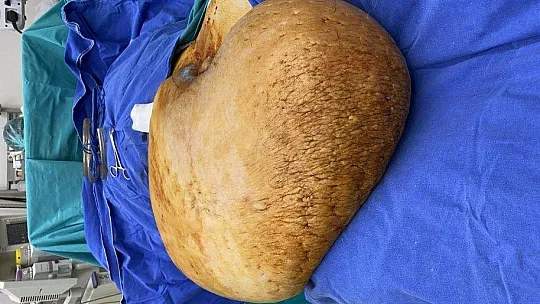 Bedeninden tam 35 kiloluk kitle çıktı