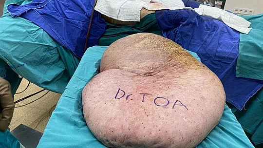 Bedeninden tam 35 kiloluk kitle çıktı