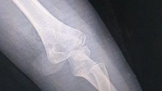 3 yaşındaki çocuğun kolunu köpek parçaladı