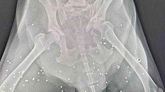 Vücudunda onlarca saçma ile yaşadığı ortaya çıktı