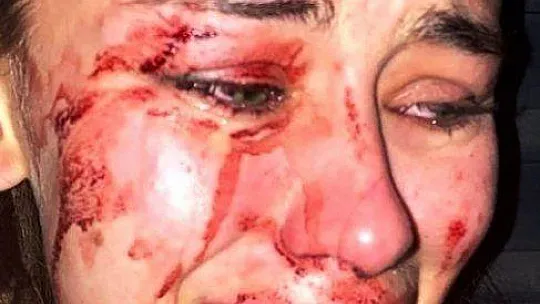 Ukraynalı model Çeşme'de darp edildikten sonra Bodrum'da ortaya çıktı