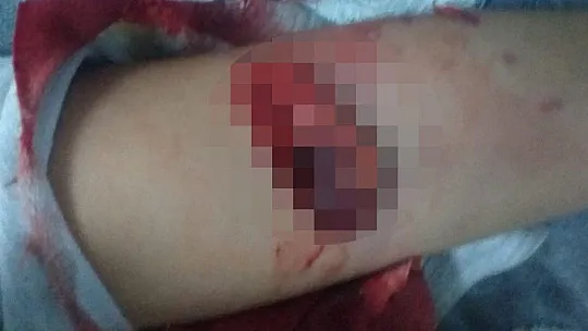3 yaşındaki çocuğun kolunu köpek parçaladı
