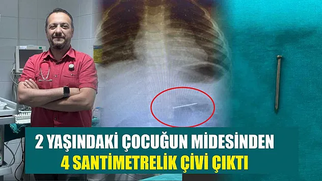 2 yaşındaki çocuğun midesinden 4 santimetrelik çivi çıktı