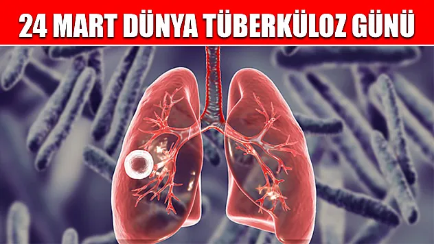 24 Mart Dünya Tüberküloz günü