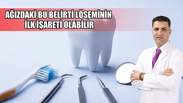 Ağızdaki bu belirti löseminin ilk işareti olabilir
