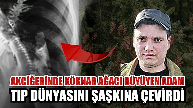 Akciğerinde Köknar Ağacı Büyüyen Adam Tıp Dünyasını Şaşkına Çevirdi