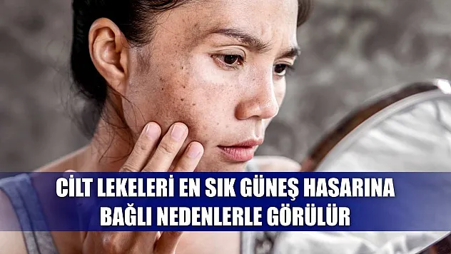 Cilt lekeleri en sık güneş hasarına bağlı nedenlerle görülür