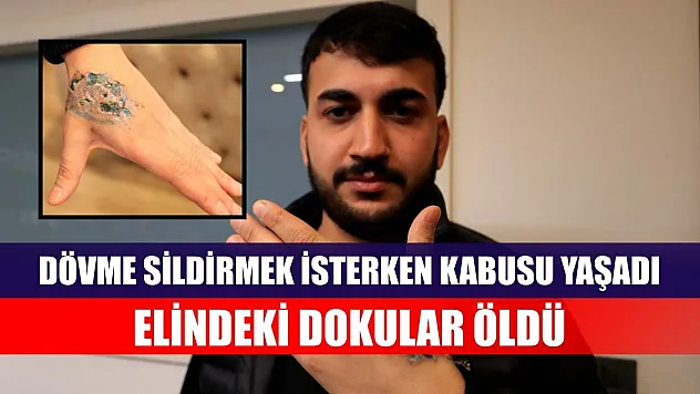 Dövme sildirmek isterken kabusu yaşadı, elindeki dokular öldü