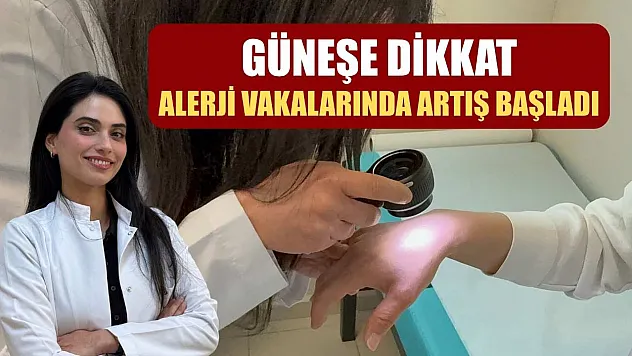 Güneşe dikkat: Alerji vakalarında artış başladı