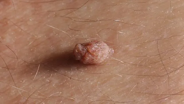 Benler Kanser Olabilir mi ?