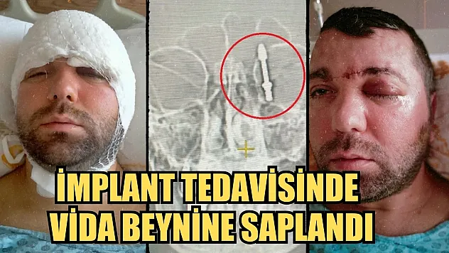 İnanılmaz olay: İmplant tedavisinde vida beynine saplandı