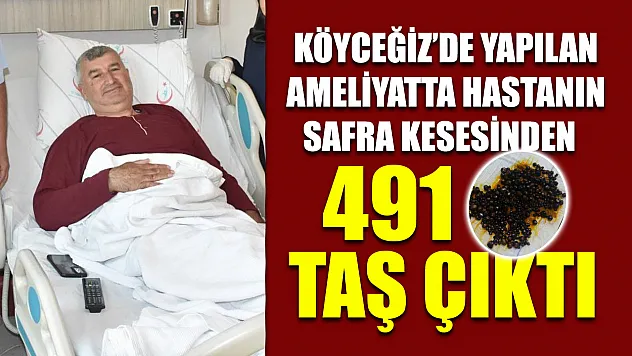 Köyceğiz'de yapılan ameliyatta hastanın safra kesesinden 491 taş çıktı